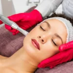 microneedling Woodstock