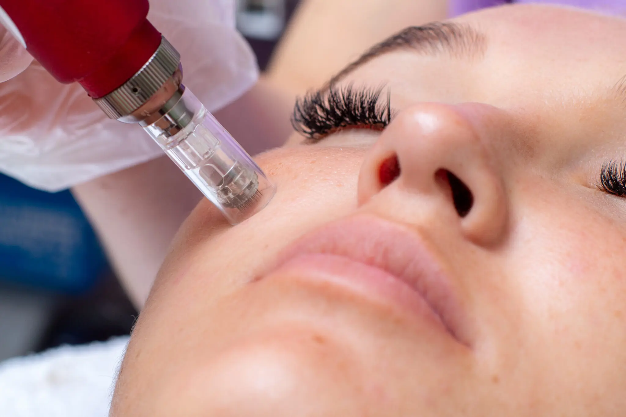 Microneedling can also improve the overall texture and firmness of the skin
