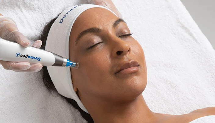 Microneedling vs. Laser Treatments